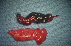 Salpingectomy with ectopic pregnancy removed from the tube
